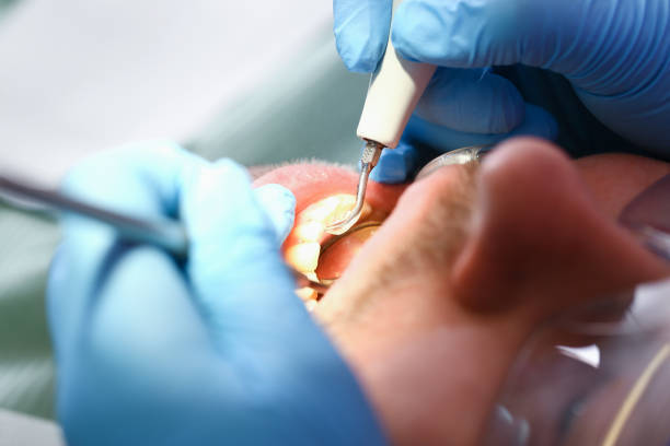 Best Emergency Root Canal Treatment in Hinton, WV